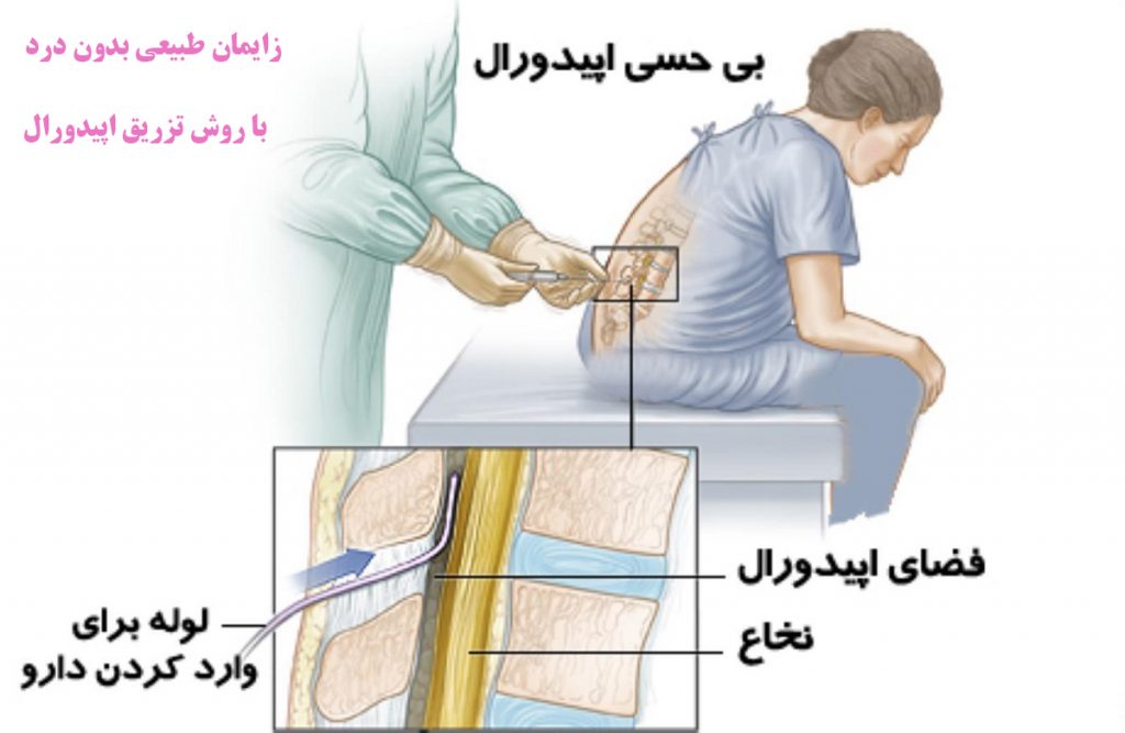 تزریق اپیدورال برای زایمان بی درد