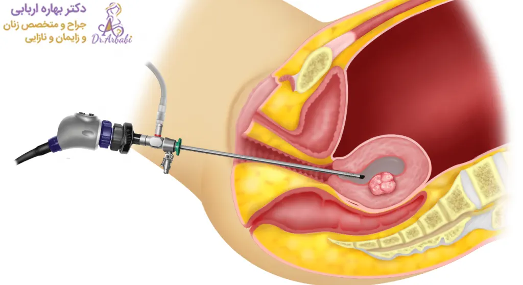 هیستروسکوپی رحم